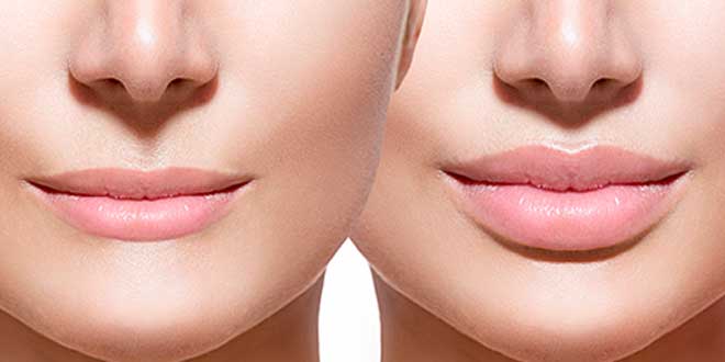 hyaluronic-acid-lips hyaluronic-acid-lips