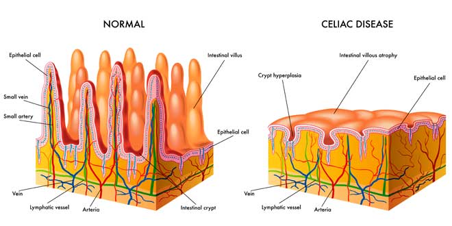 Normal vs Celiac disease