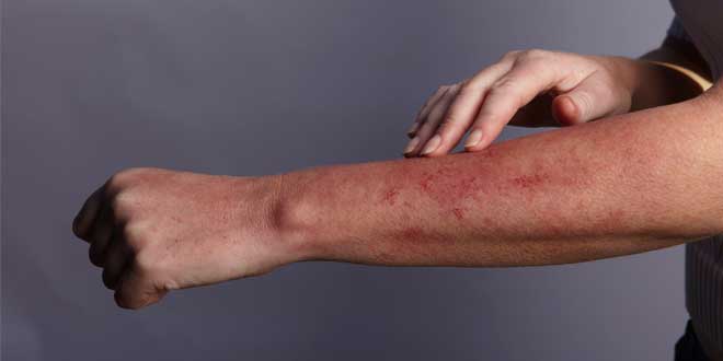 Skin rash allergy