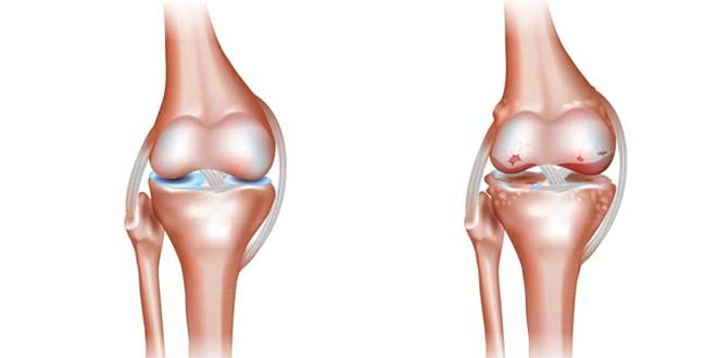 Healthy joint VS Joints affected by osteoarthritis