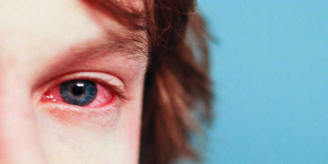 Red eye