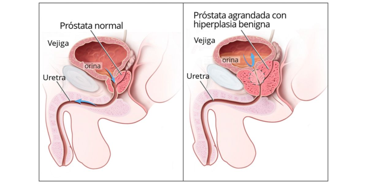 Benign Prostatic Hyperplasia BPH
