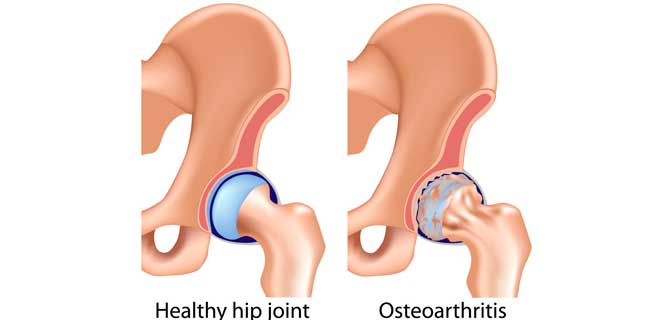 Healthy hip joint vs osteoarthritis