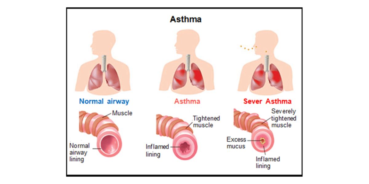 Asthma