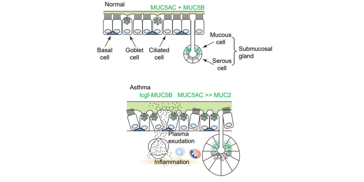 Mucus Asthma