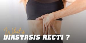 Diastasis recti