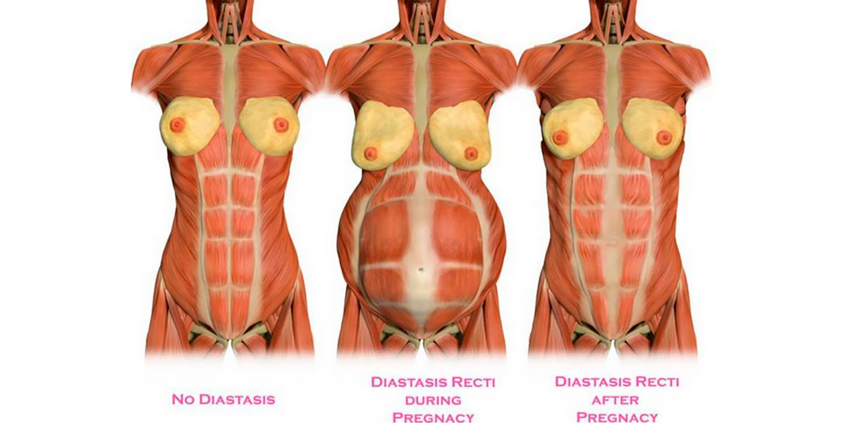 Diastasis variation pregnancy