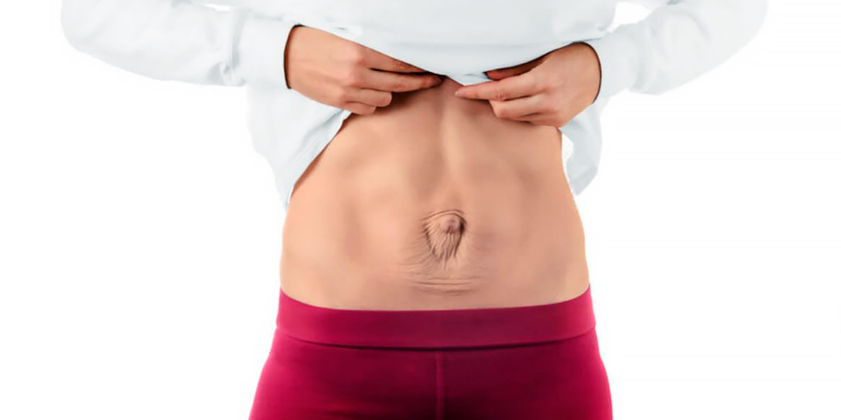 Female abdominal diastasis