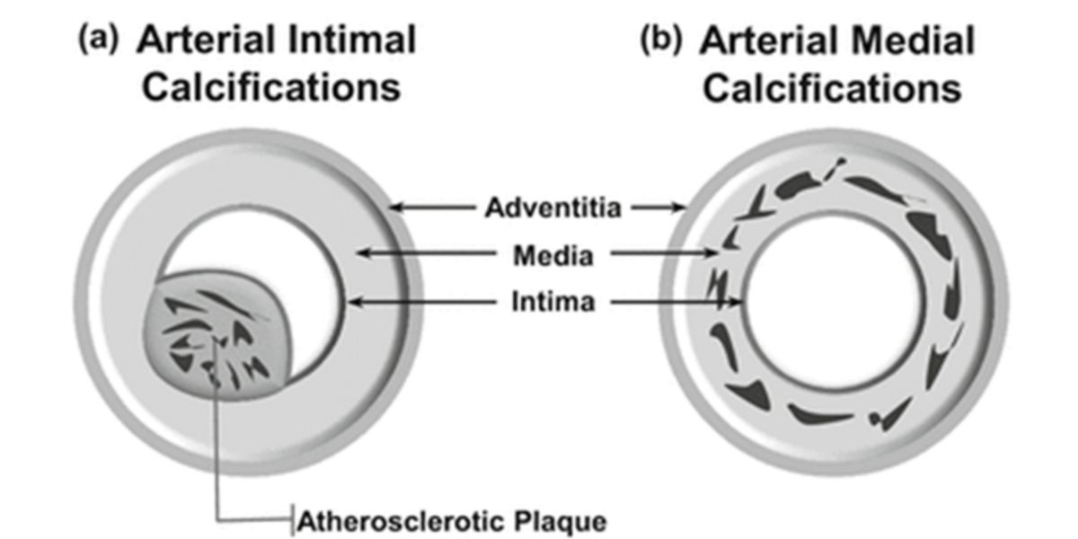 Vascular calcification Vascular calcification