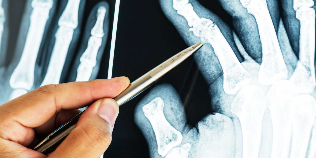Osteoporosis vitamin d