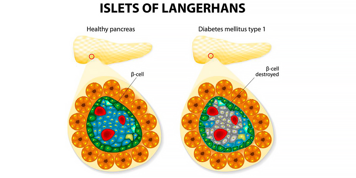 type i diabetes