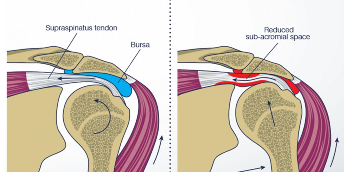 Tendinitis and Bursitis