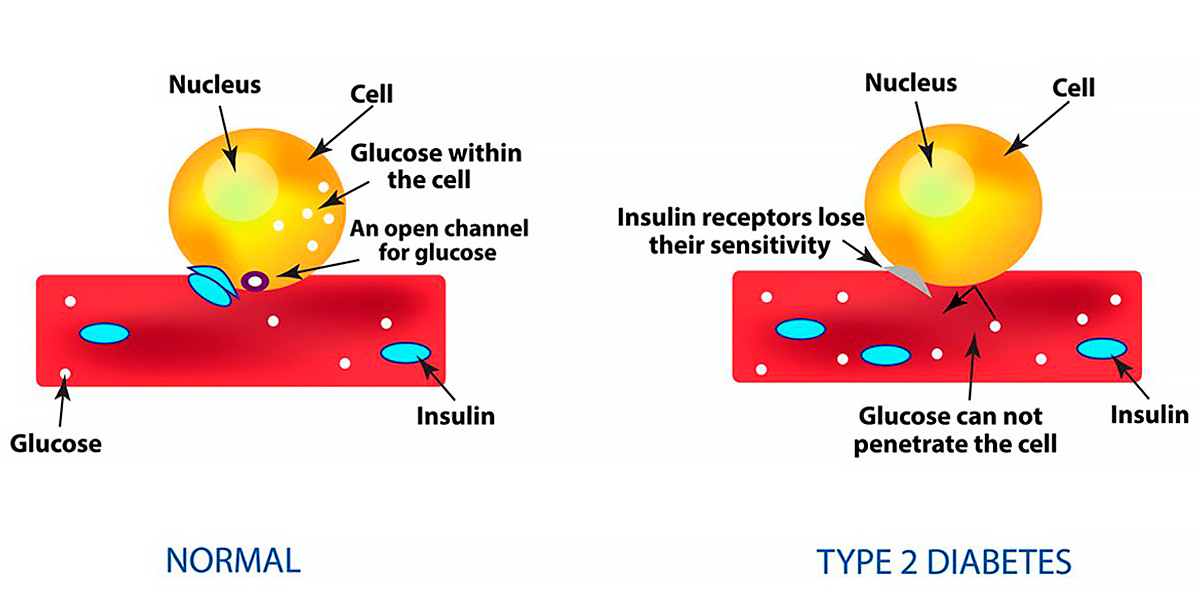type ii diabetes