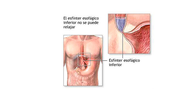 Sphincter