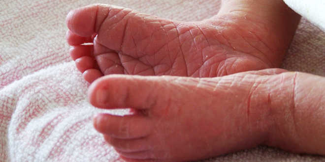 Atopic dermatitis causes Atopic dermatitis causes